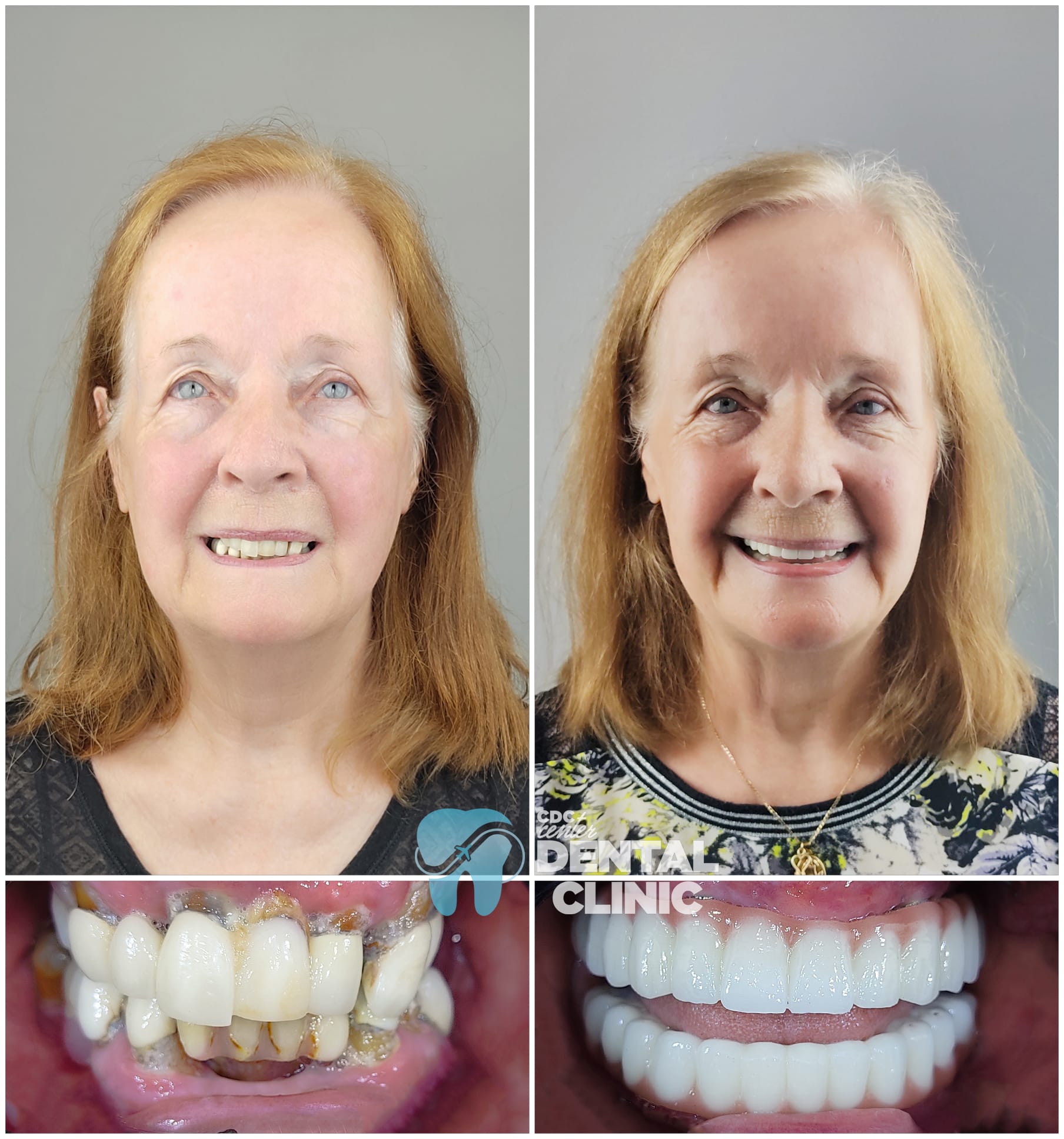 Smile Design in Antalya Turkey 14 Two Jaw All on 6