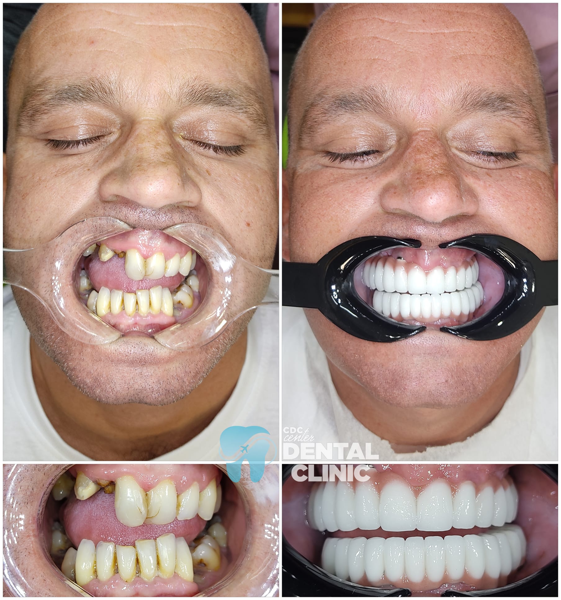 Zirconia Dental Implants Turkey 2 All on 6 and Zirconium Crowns