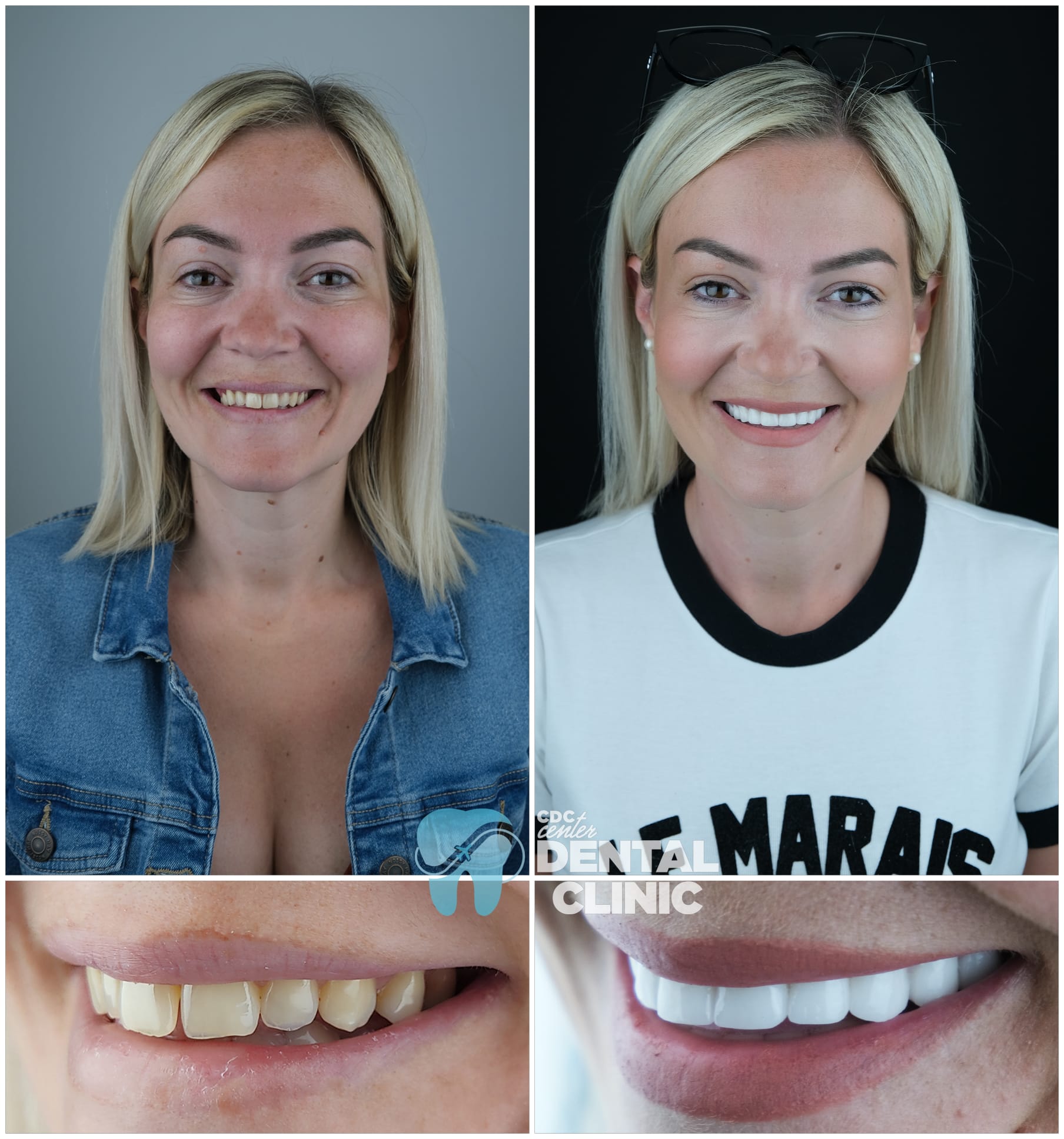 Zirconia Dental Implants Turkey 9 Zirconium Crowns