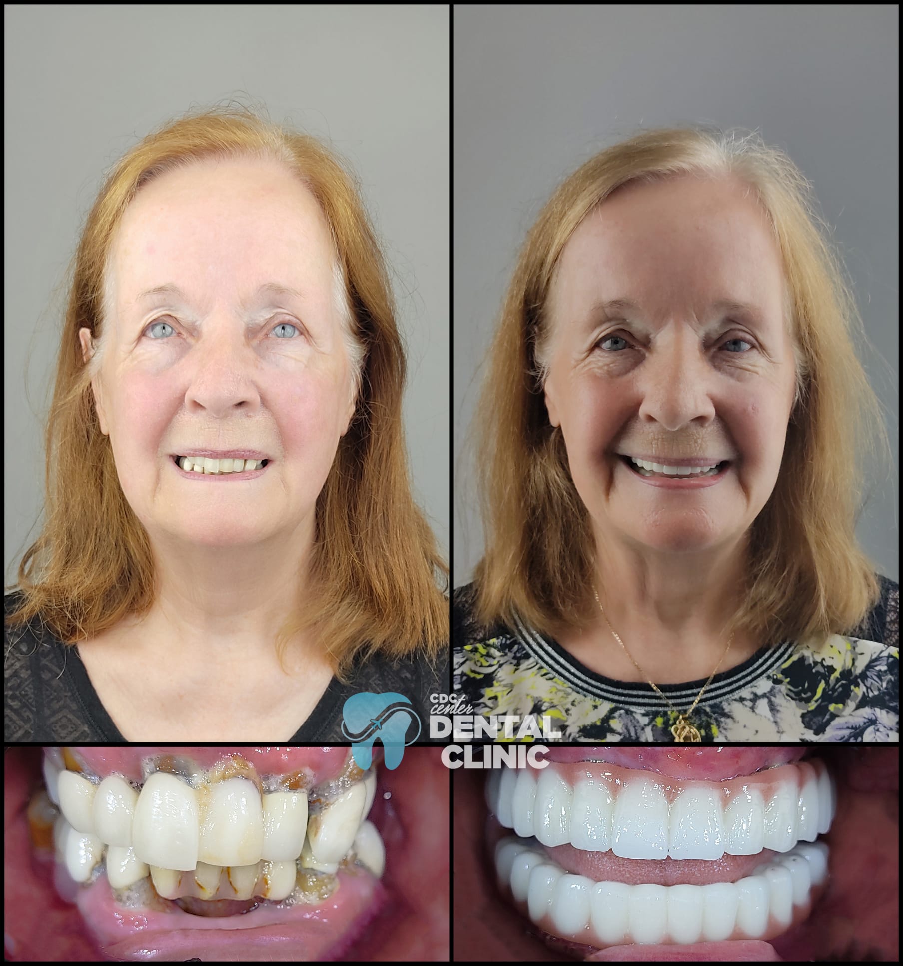 Zirconia Dental Implants Turkey 5 Two Jaw All on 6