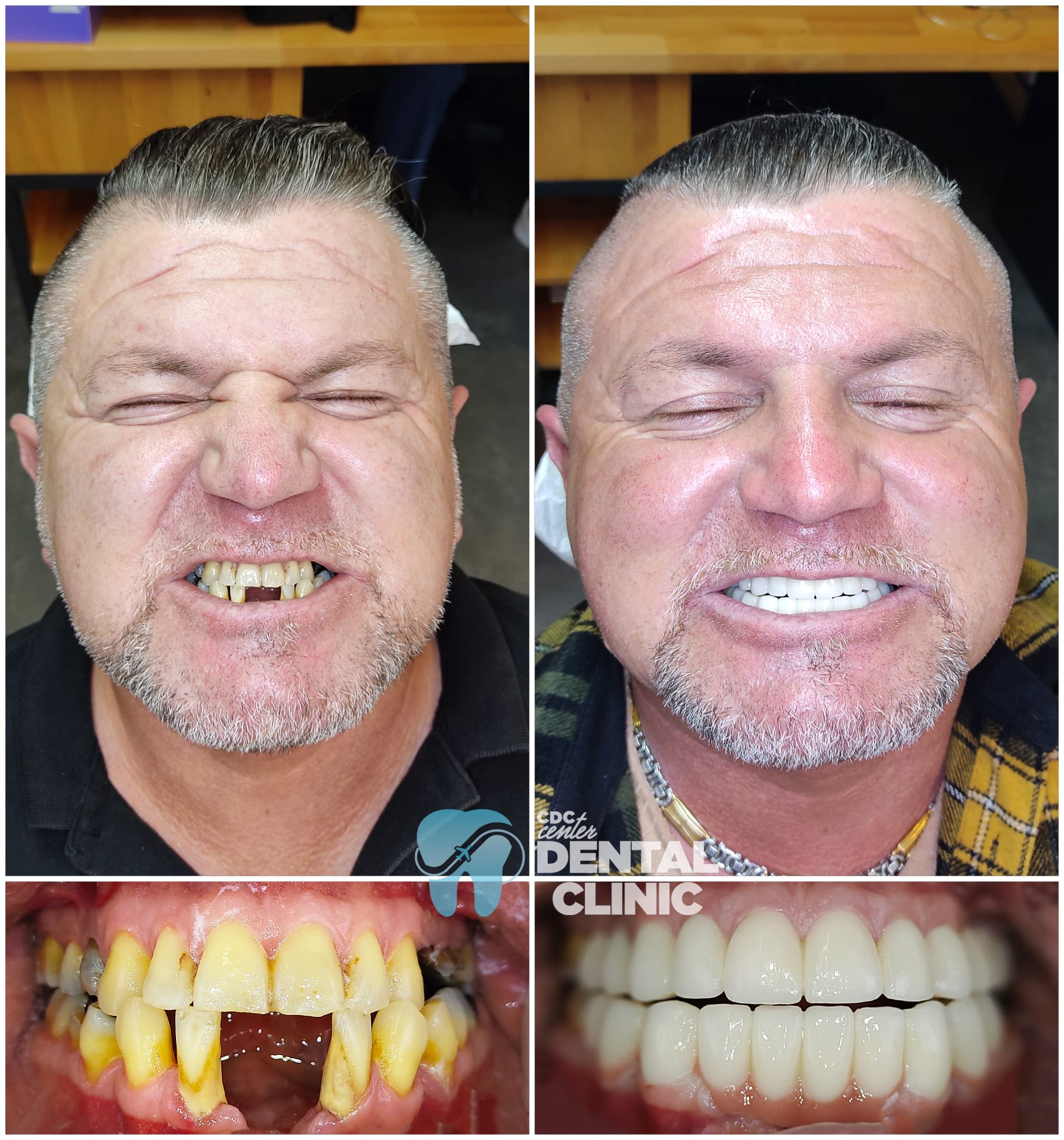 Zirconia Dental Implants Turkey 1 Dental Implants and Zirconium Crowns