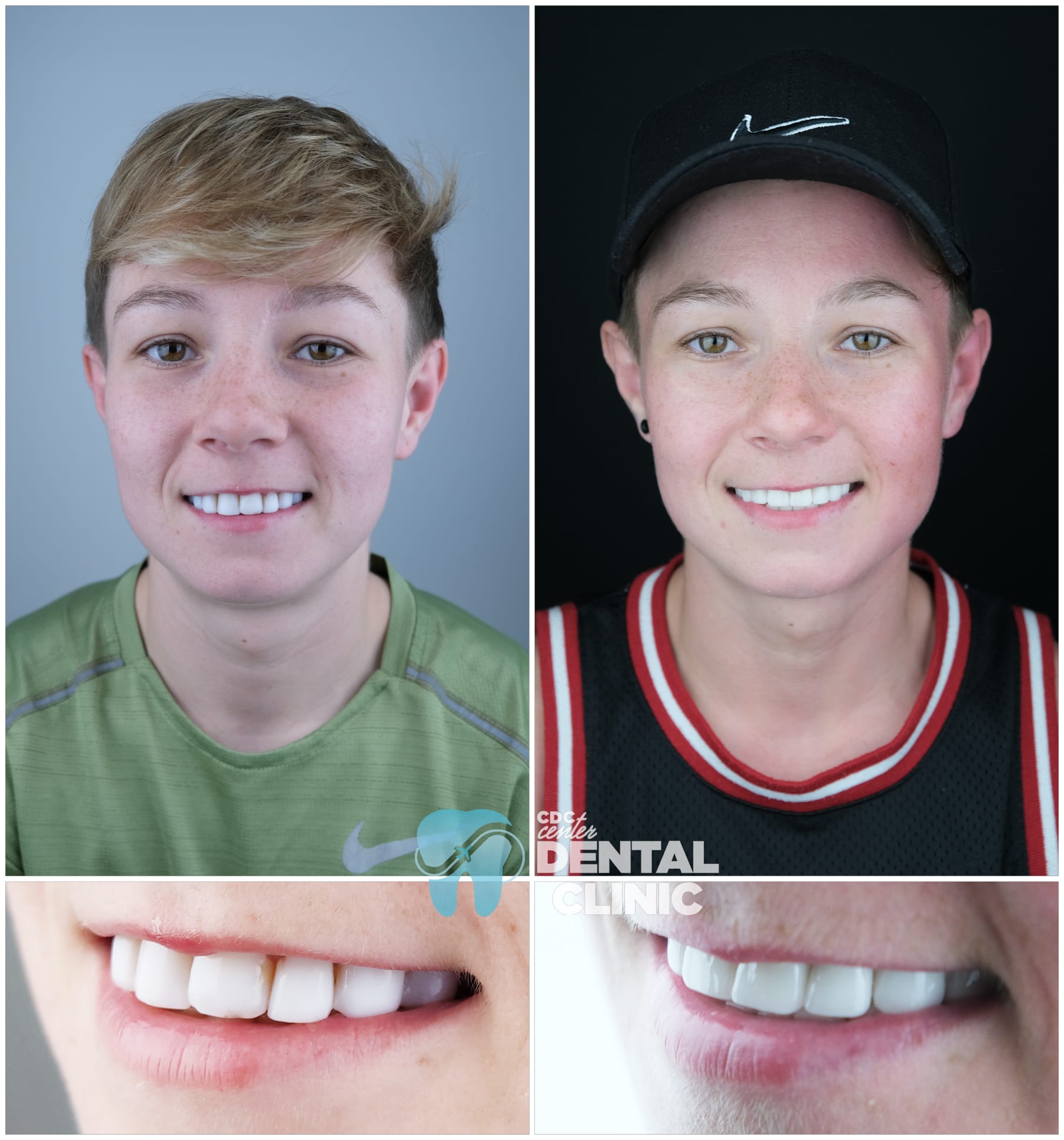 Zirconia Dental Implants Turkey 13 Zirconium Crowns