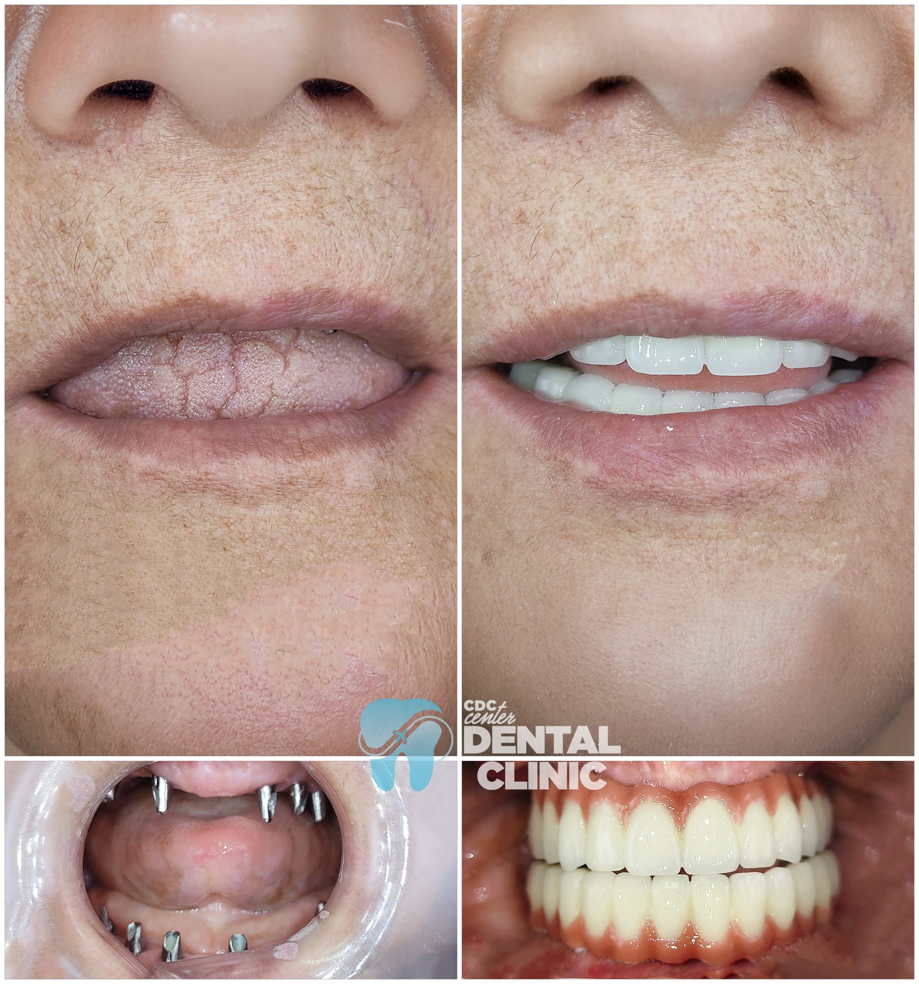 Zirconia Dental Implants Turkey 11 All on 6 and Zirconium Crowns