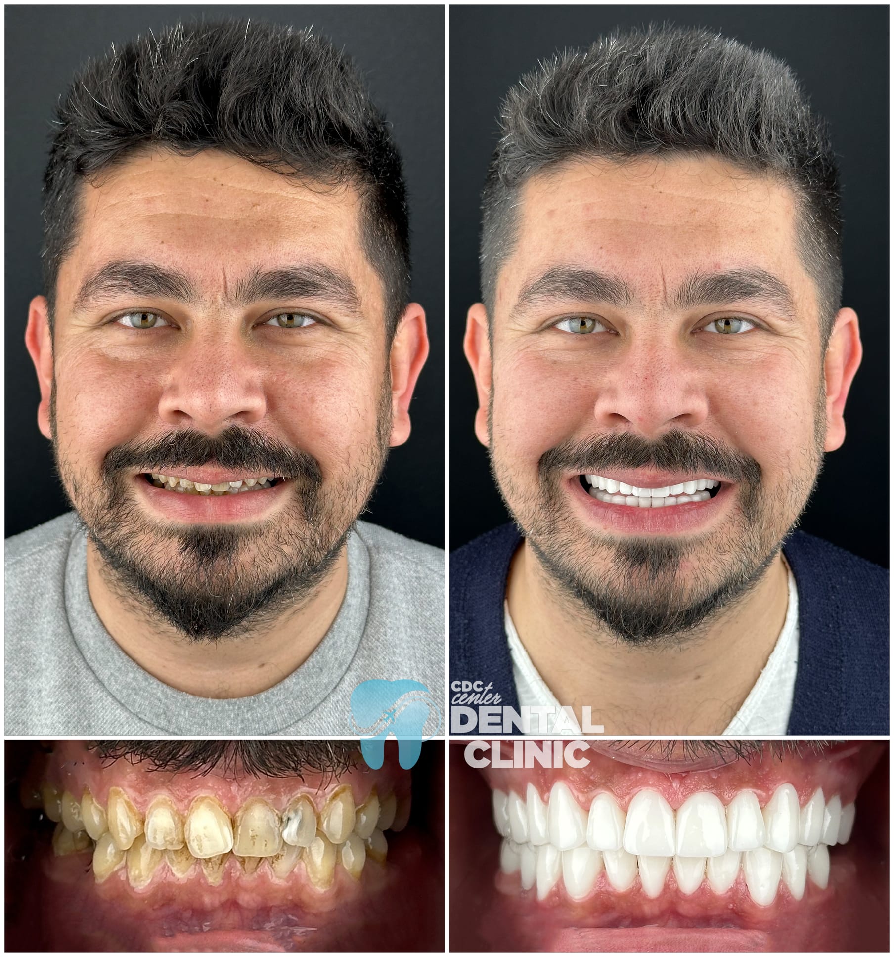 Zirconia Dental Implants Turkey 10 Zirconium Crowns