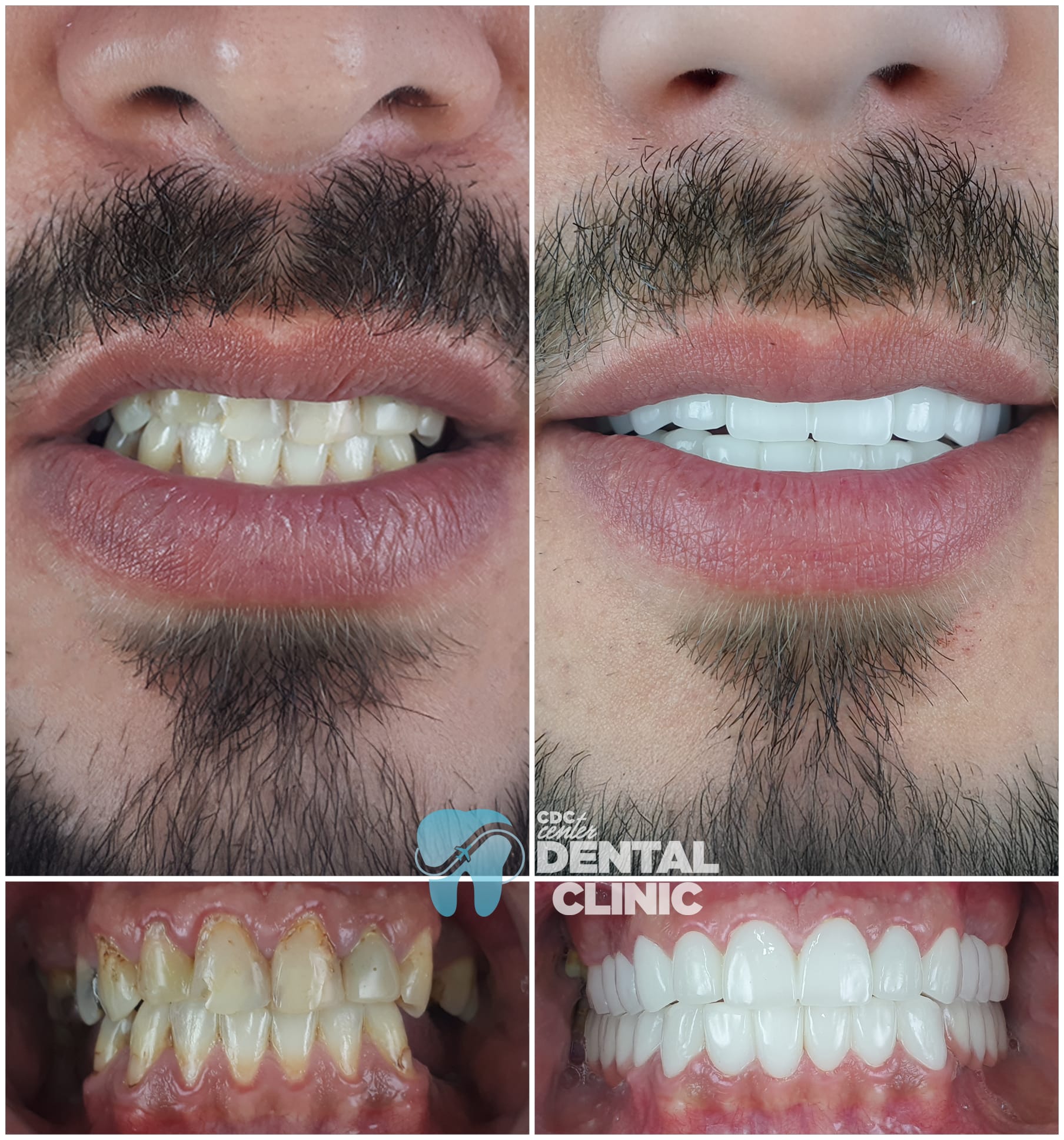 Zirconia Dental Implants Turkey 7 Zirkonium-Zahnkronen in Antalya