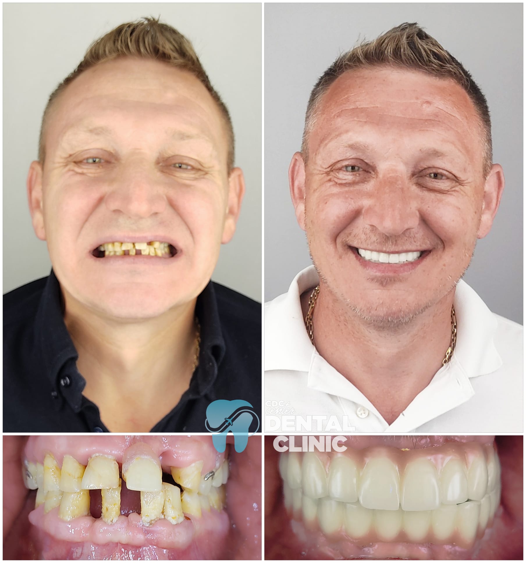 Zirconia Dental Implants Turkey 6 All on 6 and Zirconium Crowns