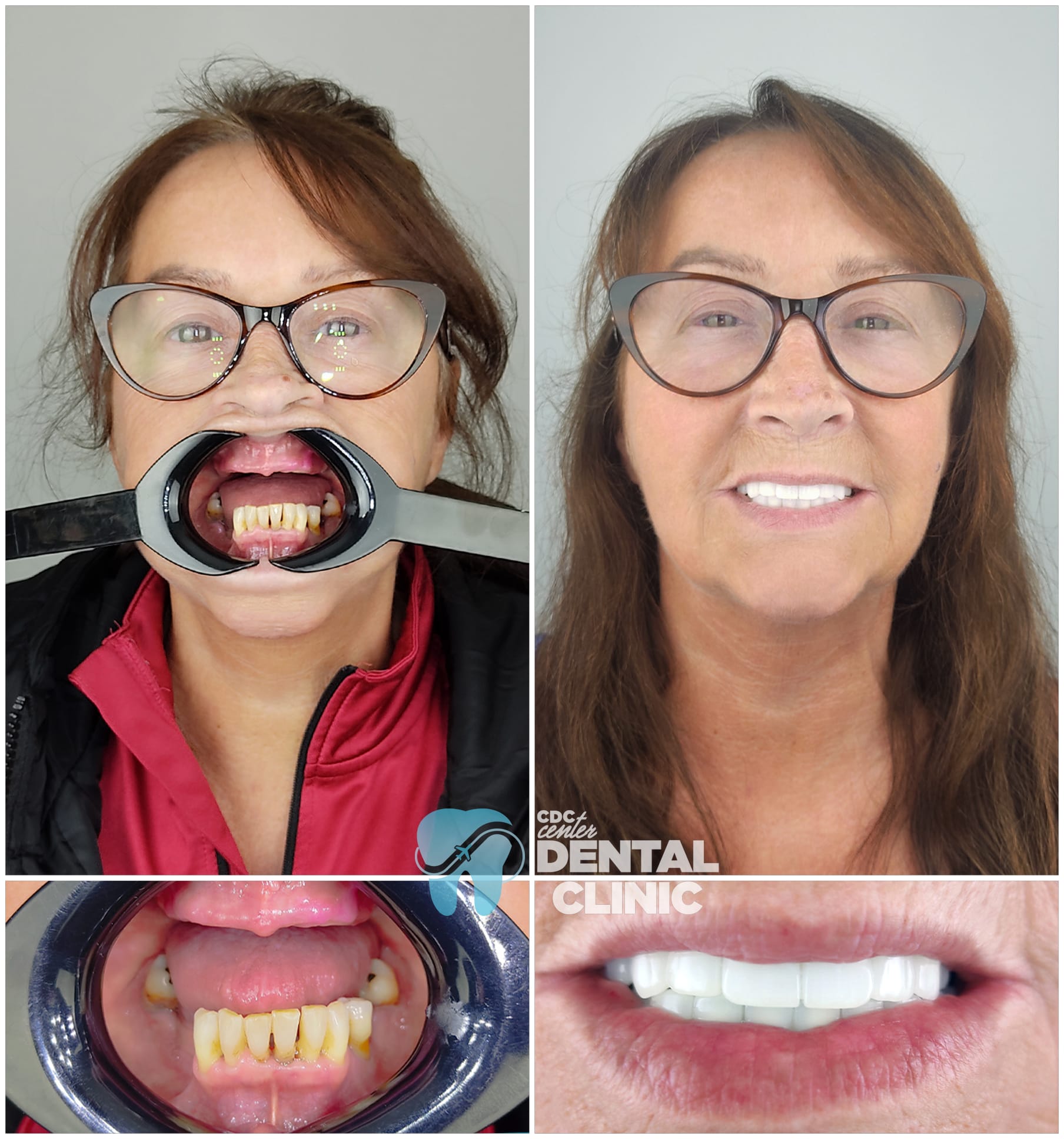 Zirconia Dental Implants Turkey 4 All on 6 and Zirconium Crowns