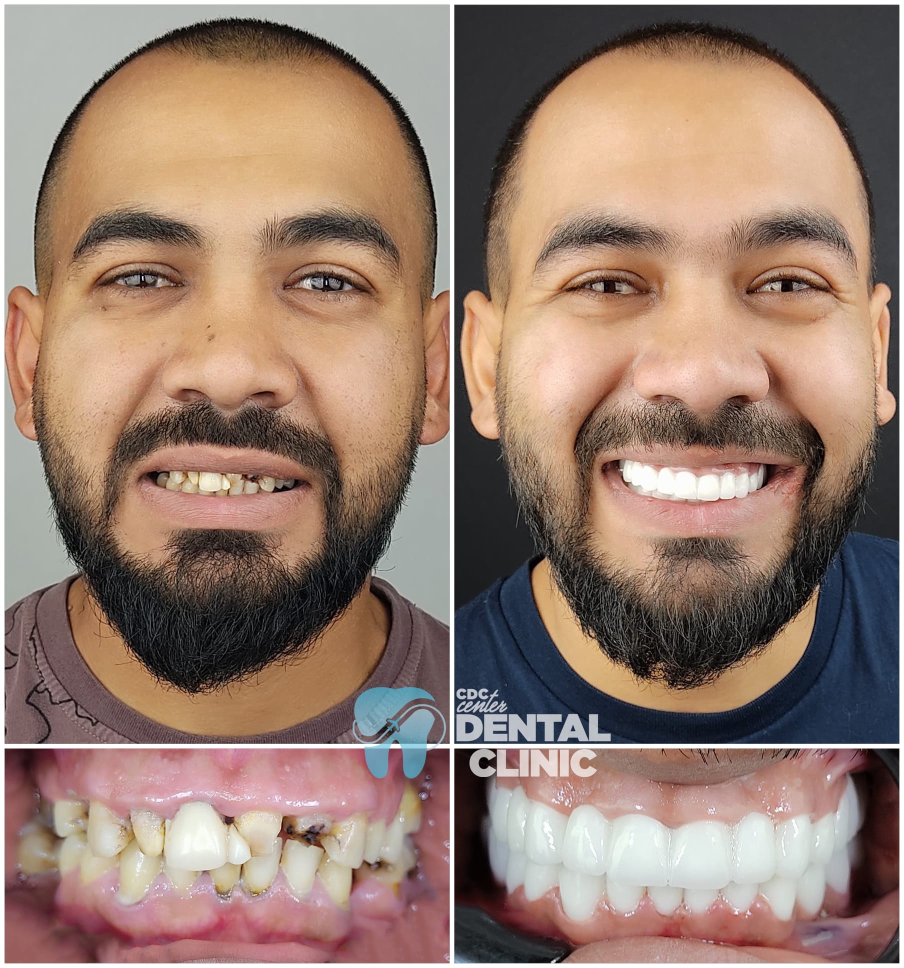 Zirconia Dental Implants Turkey 3 Zirconium Dental Crowns in Antalya