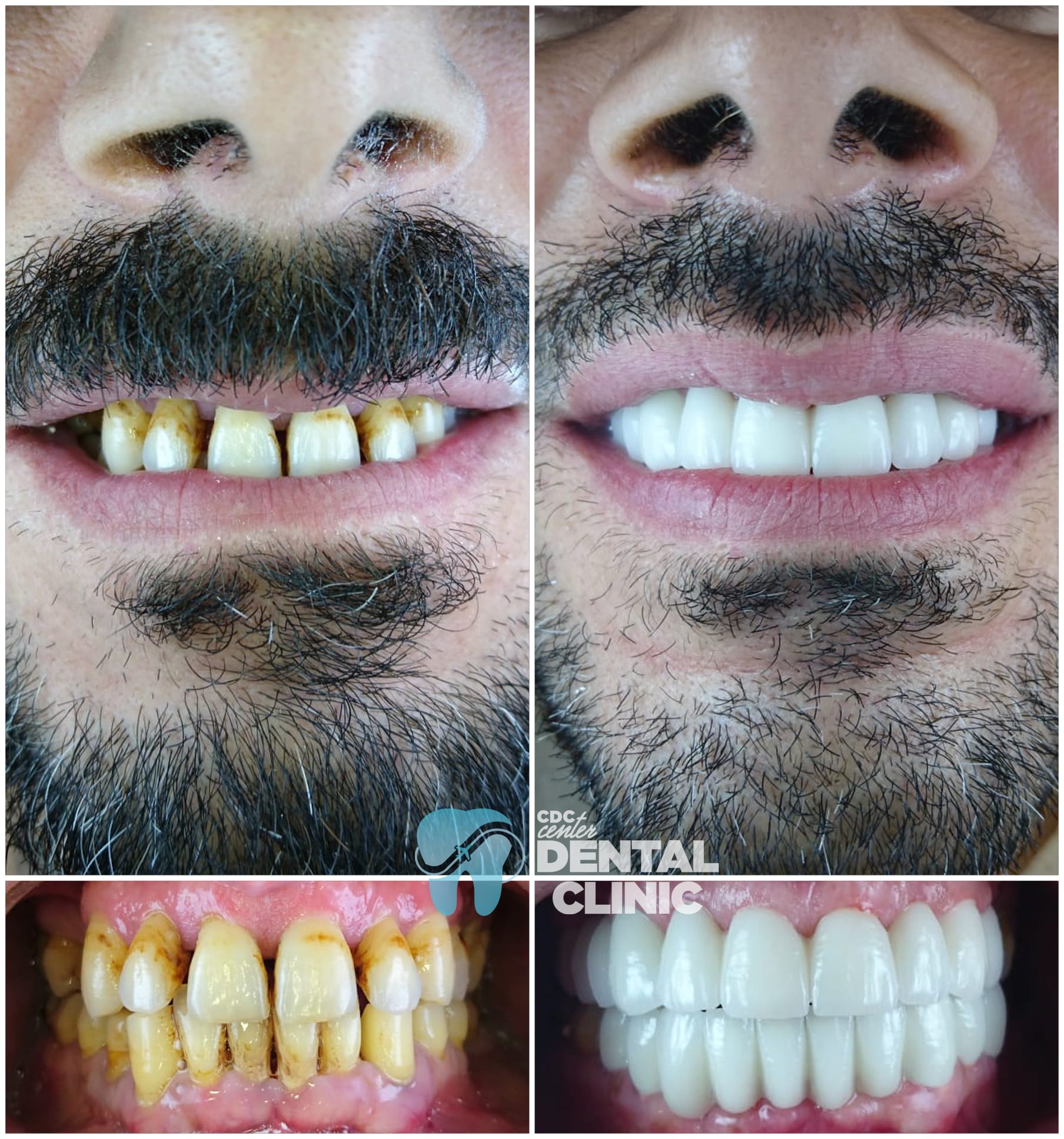 Zirconia Dental Implants Turkey 8 Zirconium Crowns