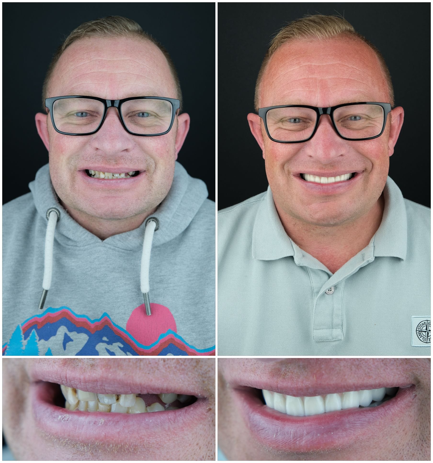 Zirconia Dental Implants Turkey 14 All on 6 and Zirconium Crowns