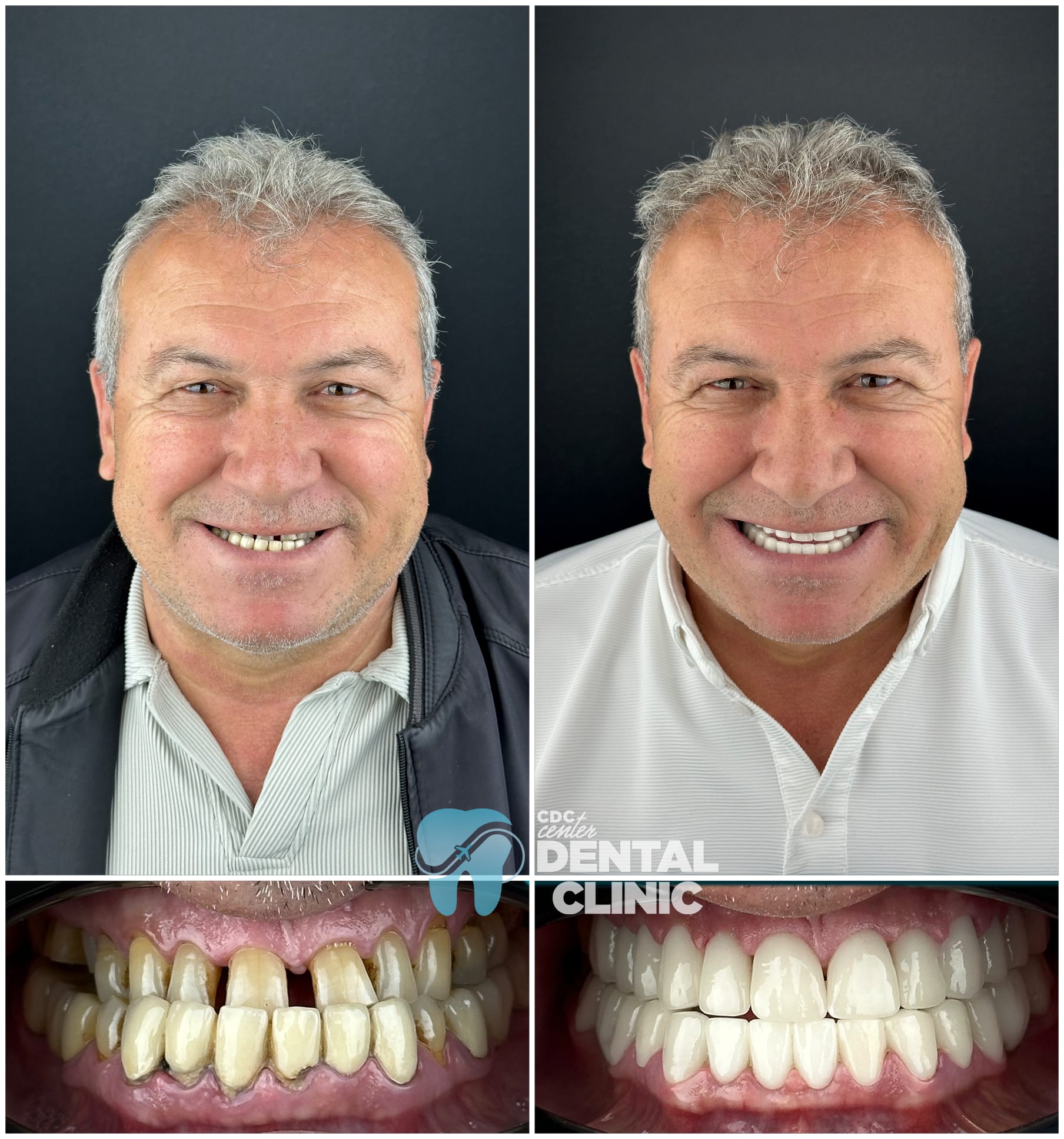 Zirconia Dental Implants Turkey 12 Zirconium Crowns