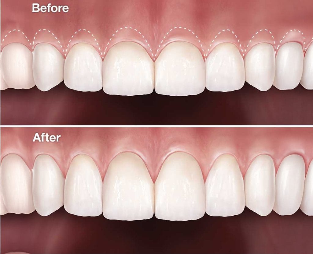 Aesthetic Gum Treatment in Antalya 15 Aesthetic Gum Treatment in Antalya Turkey