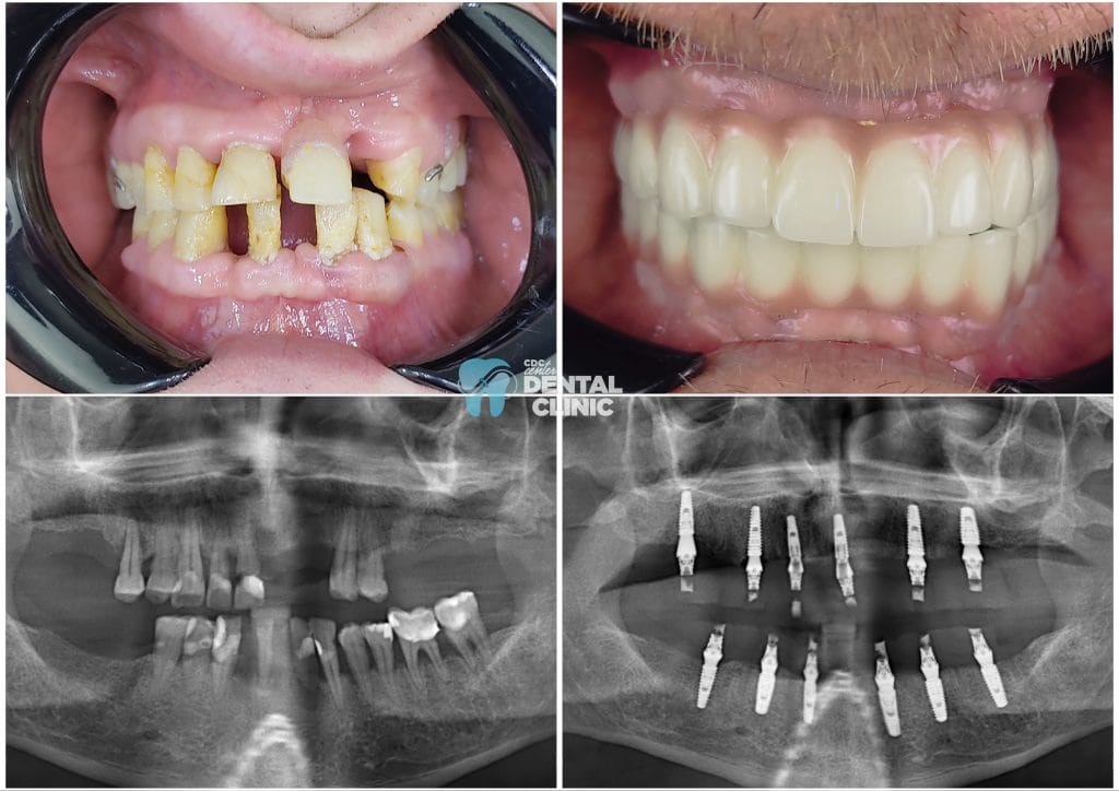 All on 4 Implants Antalya Turkey