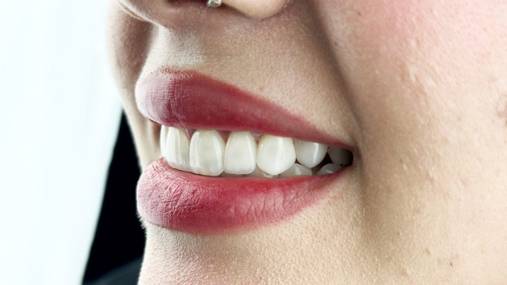 Hollywood Smile in Antalya 15 Hollywood Smile in Antalya Turkey