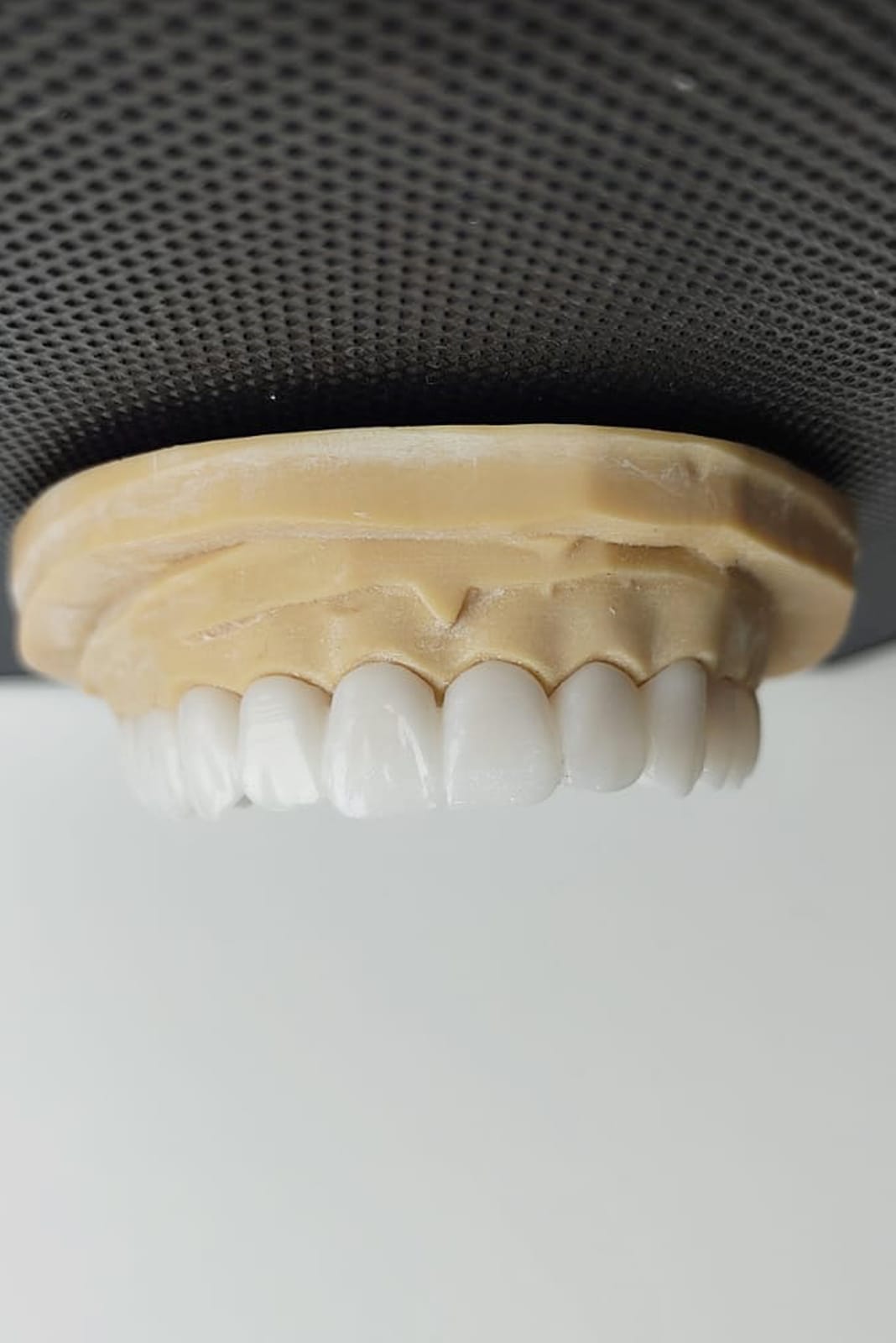 Porcelain Crowns in Antalya Turkey 16 Porcelain Crowns in Antalya Turkey