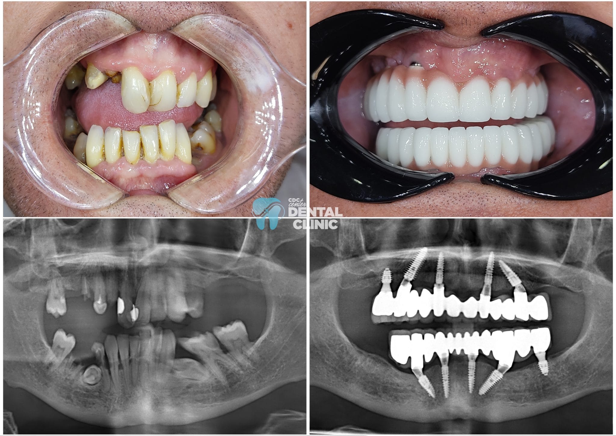 All On 4-6 Implants in Antalya 15 All on Six in Antalya Turkey | All On 4-6 implants