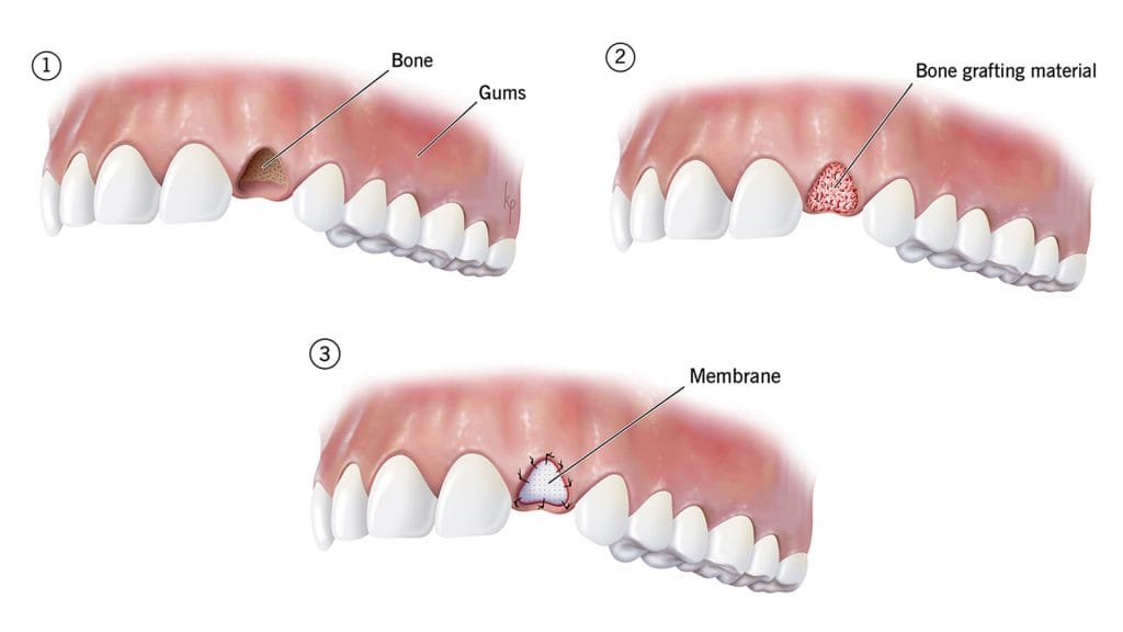 Bone Grafting in Antalya 15 Bone Grafting dental in Antalya turkey
