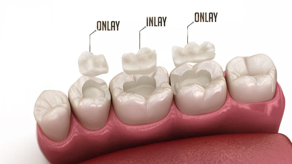 Inlay and Onlay Restorations in Antalya 15 Inlay and Onlay Restorations in Antalya turkey
