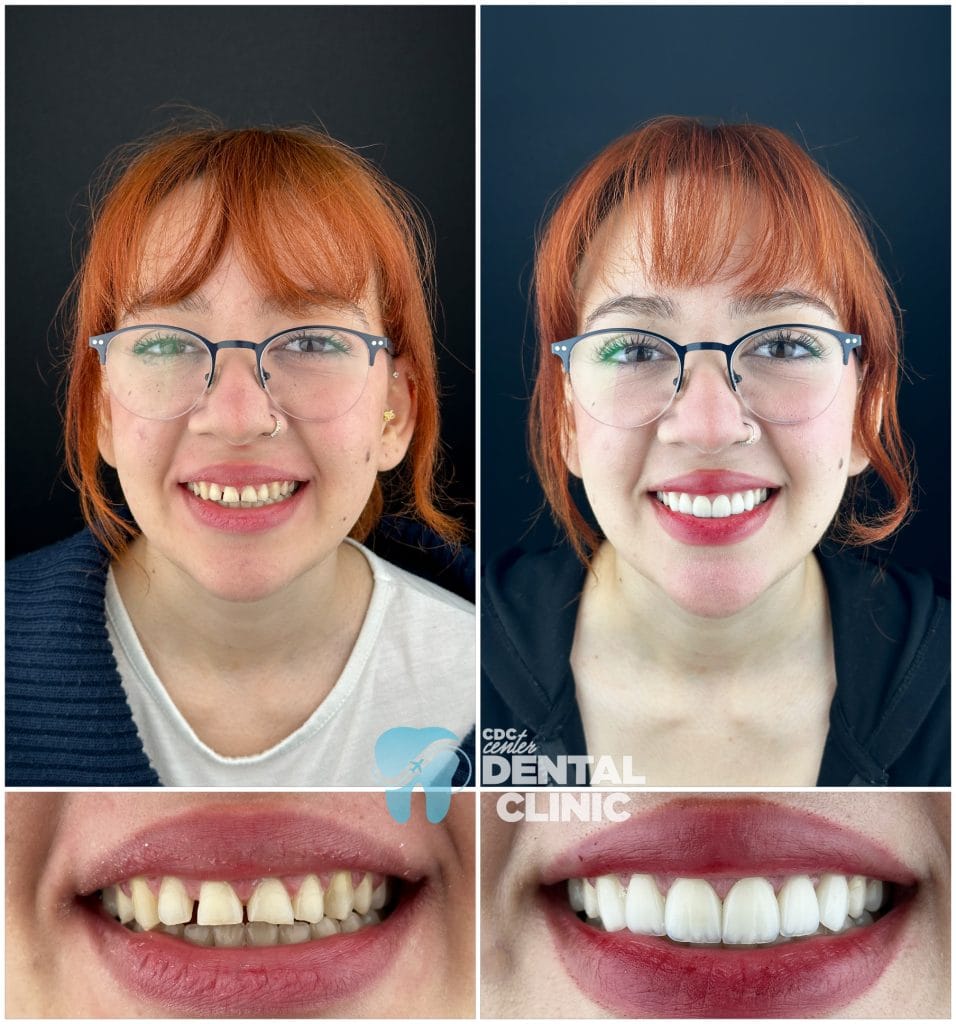 Dental Veneers in Antalya 15 Dental Veneers in antalya turkey