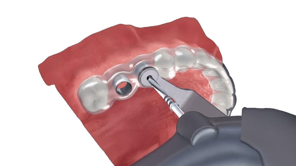 Non Surgical Dental Implant in Antalya 15 Non Surgical Dental Implant in antalya turkey