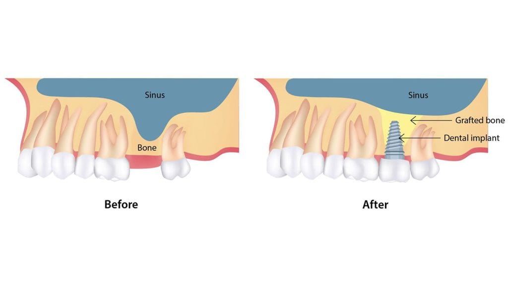 Sinus Lifting in Antalya 15 Sinus Lifting dental in Antalya Turkey