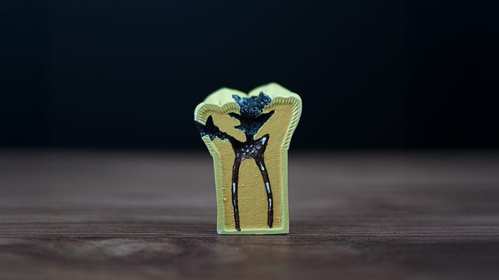 Tooth Extraction in Antalya Turkey