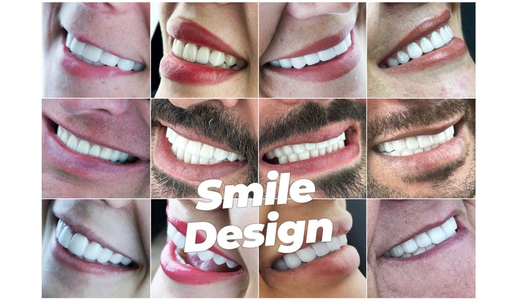 Smile Design in Antalya Turkey 1 Smile Design in Antalya Turkey