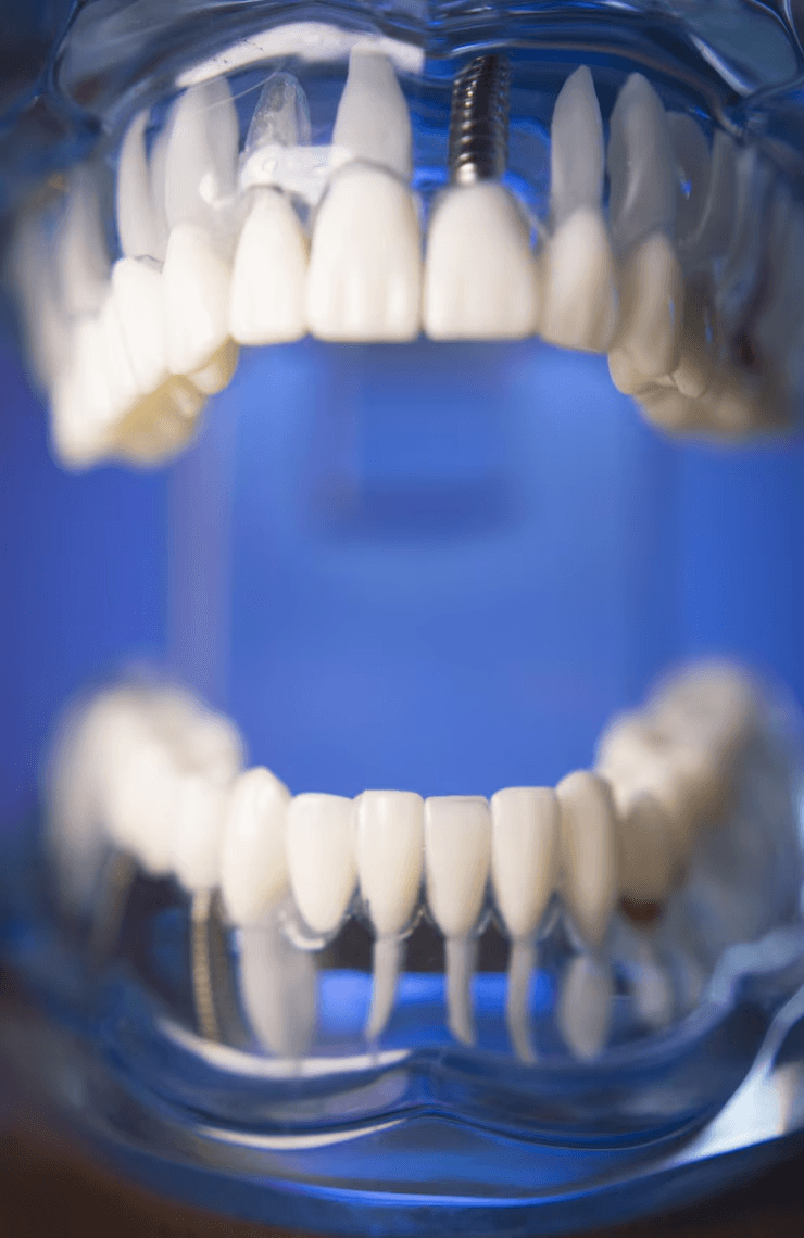 dental bridge antalya