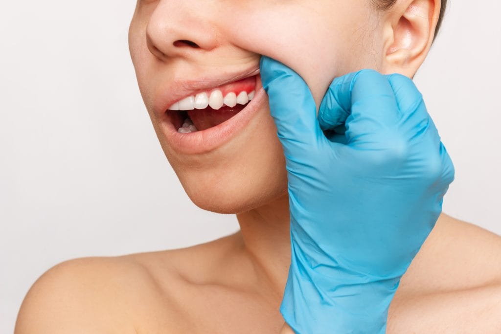 Aesthetic Gum Treatment in Antalya Turkey