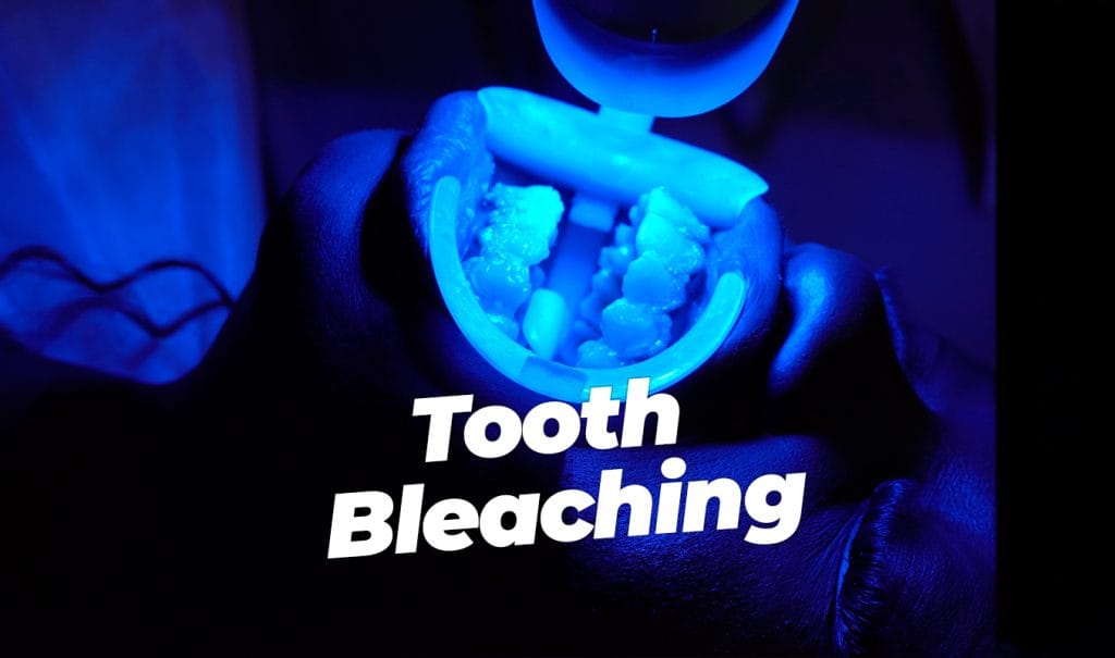 Tooth Bleaching in Antalya Turkey 1 tooth bleaching in antalya turkey