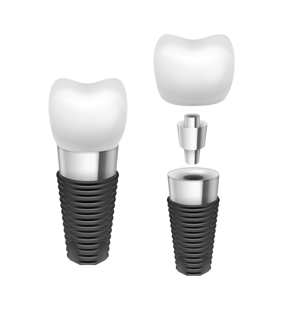 Zirconia Dental Implants Turkey 15 Zirconia Dental Implants Turkey