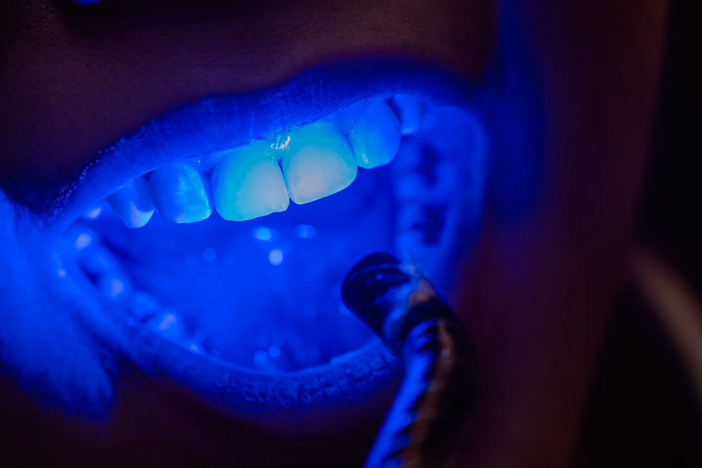 Teeth Whitening Side Effects