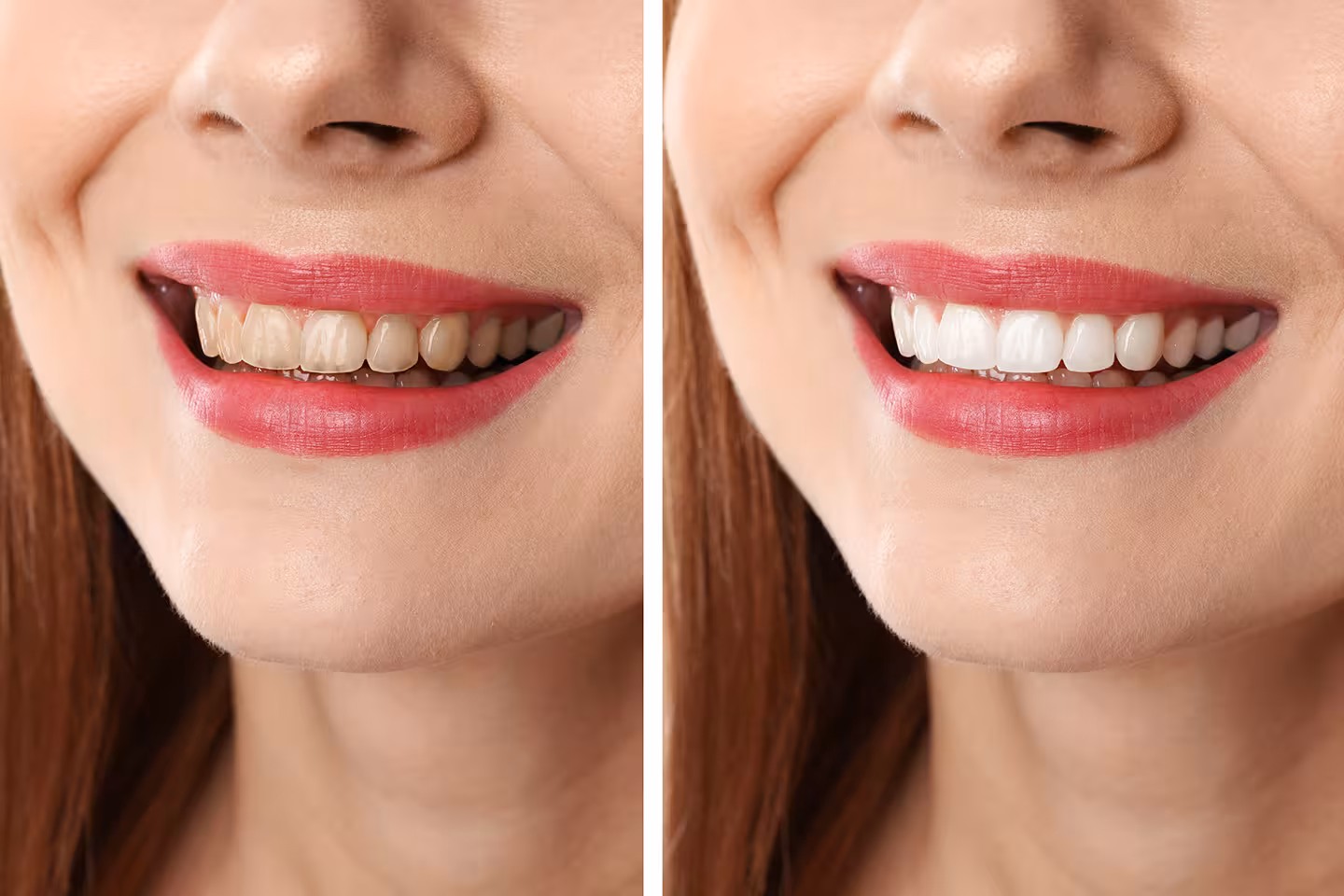 Patient comparing composite and porcelain veneer options at Center Dental Clinic Antalya
