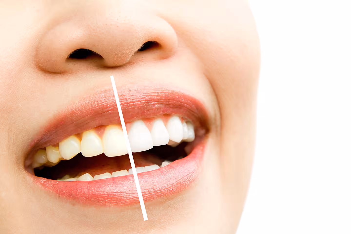 Veneers for teeth before and after planning at Center Dental Clinic Antalya